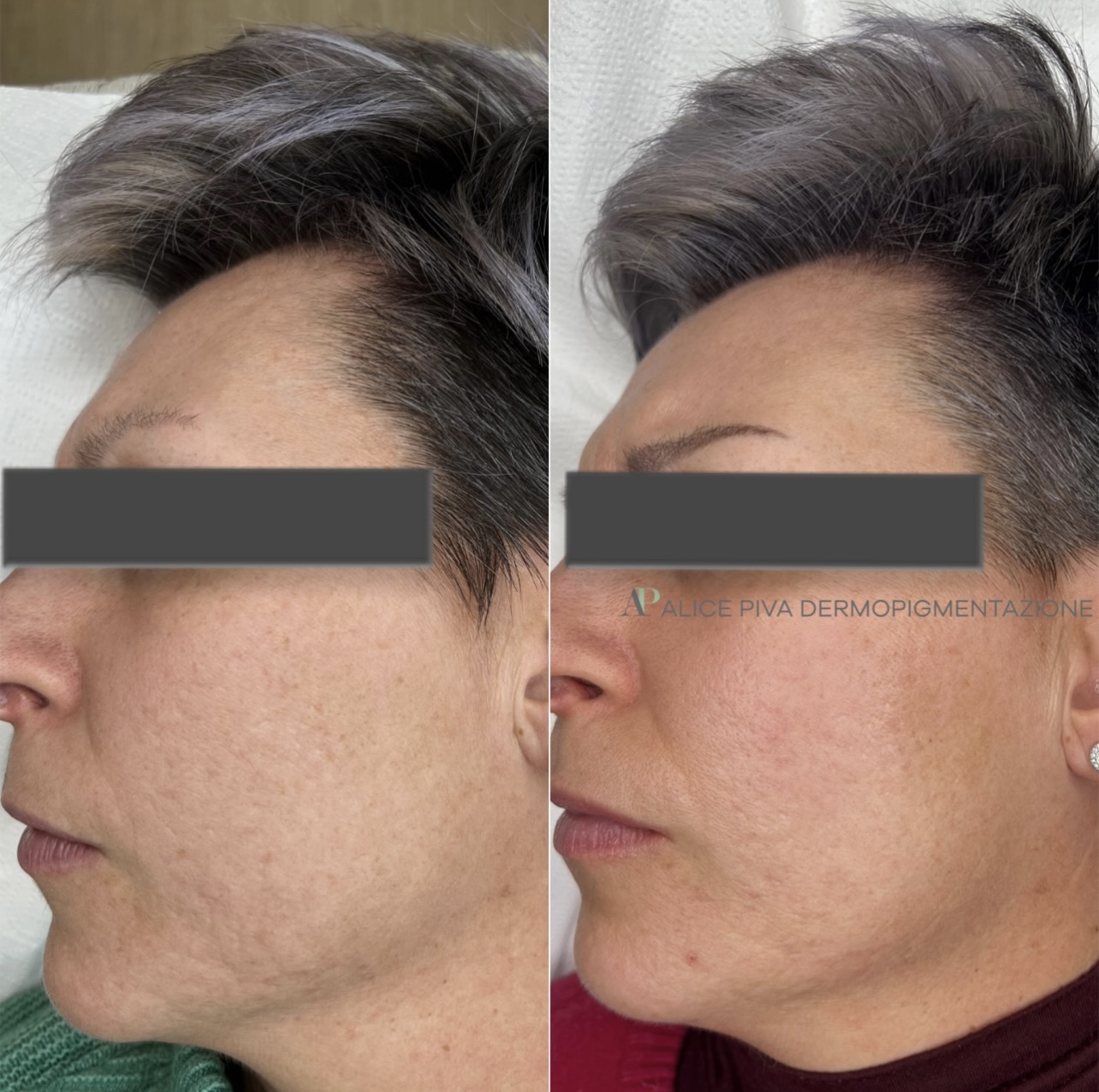 Risultato Needling su cicatrici da acne